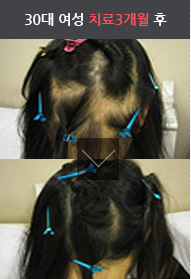 30대 여성 치료 3개월 전후 사진