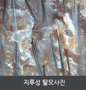 지루성 탈모사진