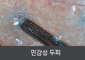 민감성 두피