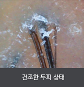 건조한 두피 상태 