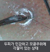 두피가 민감하고 모공주위에  각질이 있는 상태