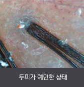 두피가 예민한 상태 