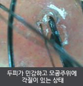 두피가 민감하고 모공주위에  각질이 있는 상태