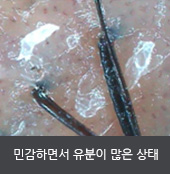 민감하면서 유분이 많은 상태