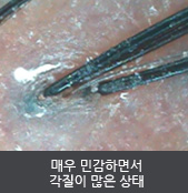 매우 민감하면서 각질이 많은 상태