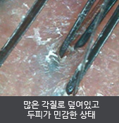 많은 각질로 덮여있고 두피가 민감한 상태