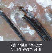 많은 각질로 덮여있는 두피가 민감한 상태