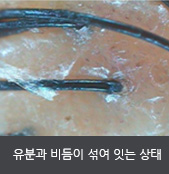 유분과 비듬이 섞여 잇는 상태 