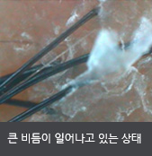 큰 비듬이 일어나고 있는 상태 