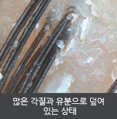 많은 각질과 유분으로 덮여  있는 상태