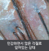 민감하면서 많은 각질로  덮여있는 상태