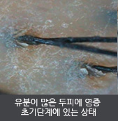 유분이 많은 두피에 염증  초기단계에 있는 상태 