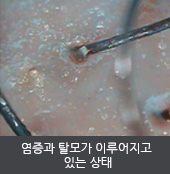 염증과 탈모가 이루어지고  있는 상태 