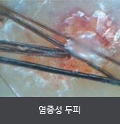 염증성 두피