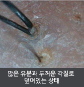 많은 유분과 두꺼운 각질로 덮여있는 상태