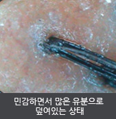 민감하면서 많은 유분으로  덮여있는 상태