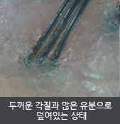 두꺼운 각질과 많은 유분으로  덮여있는 상태   