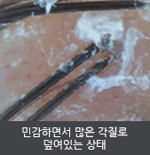 민감하면서 많은 각질로 덮여있는 상태 