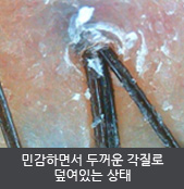 민감하면서 두꺼운 각질로 덮여있는 상태 