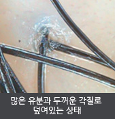 많은 유분과 두꺼운 각질로  덮여있는 상태