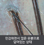 민감하면서 많은 유분으로  덮여있는 상태