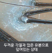 두꺼운 각질과 많은 유분으로  덮여있는 상태   