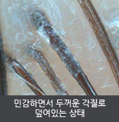 민감하면서 두꺼운 각질로 덮여있는 상태 