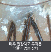 매우 민감하고 두꺼운 각질이 있는 상태