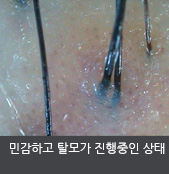 민감하고 탈모가 진행중인 상태 