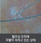 탈모성 두피에 모발이 자라고 있는 상태  