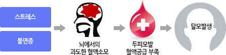 스트레스,불면증 > 뇌에서의 과도한 혈액소모 > 두피모발 혈액공급 부족 > 탈모발생