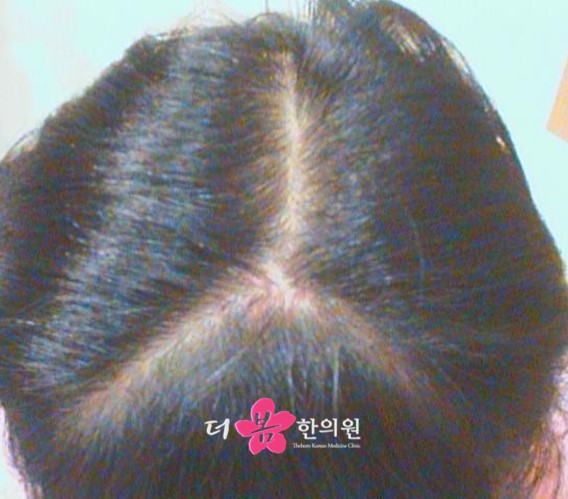 치료 전 사진입니다.